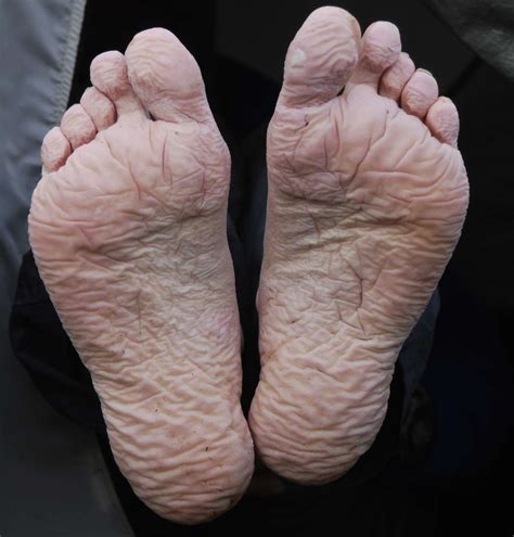 Trench Foot Symptoms Causes Diagnosis Treatment And More