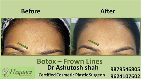 Glabellar Frown Lines Botox Treatment In Surat Gujarat India