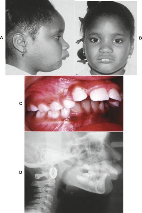 13 Treatment Of Class Ii Malocclusions Pocket Dentistry
