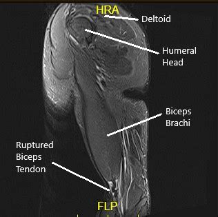 Estudio de caso Manejo de la rotura distal del bíceps en 38 años