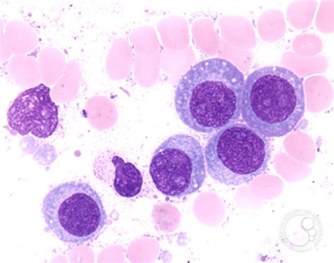 Plasma Cell Leukemia 3