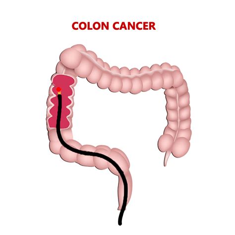 Colon (anatomy) front of abdomen, showing surface markings for liver the colon is the last part of the digestive system in most vertebrates; Best Cancer Hospital in India | Colon Cancer Treatment in ...