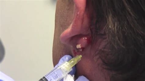 Bloody Cyst Behind The Ear Drained New Pimple Popping Videos