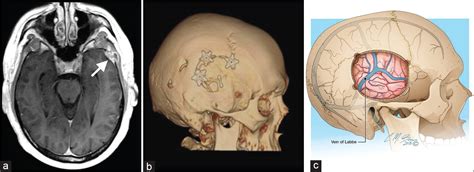 An Illustrative Review Of Common Modern Craniotomies Journal Of