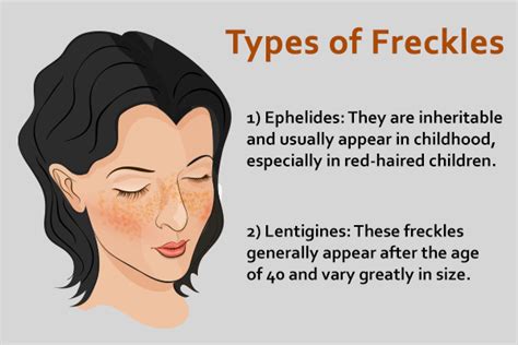 Freckles Types Causes And Treatment Emedihealth