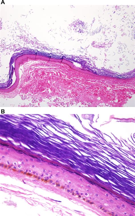 Giant Epidermal Inclusion Cyst Of The Axilla A Case Report With