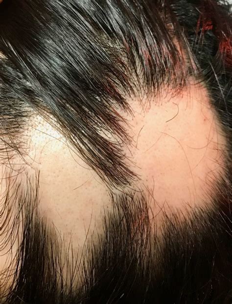 Alopecia Areata Symptoms Treatments Holborn Clinic