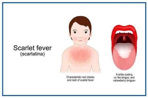 Scarlet Fever Symptoms Costamedic