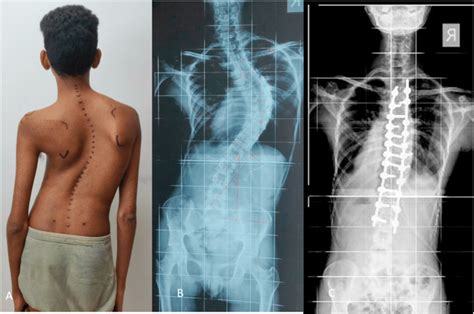 A Adolescent Idiopathic Scoliosis Lenke 1 Curve With Clinical Photo Download Scientific