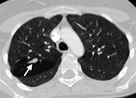 Bronchial Atresia Ct Scan Shows Mucoid Impaction Arrow Just Distal