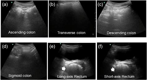Ultrasonographic Follow Up Of Functional Chronic Constipation In Adults