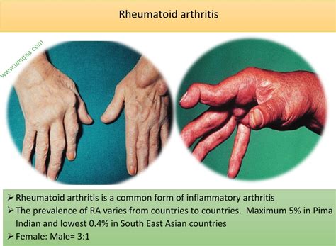 What Are The Diagnostic Criteria For Rheumatoid Arthritis