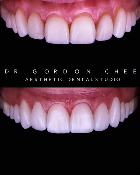 Aesthetic Dental Studio Before And After Photos