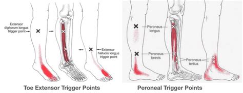 Trigger Points For Plantar Fasciitis How To Find And Release