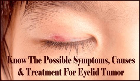 Know The Possible Symptoms Causes And Treatment For Eyelid Tumor In Adults
