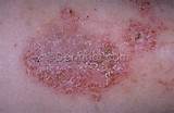 Eczema Skin Disease Treatment