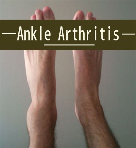 Best 25 Ankle Arthritis Ideas On Pinterest Trigger Points Body