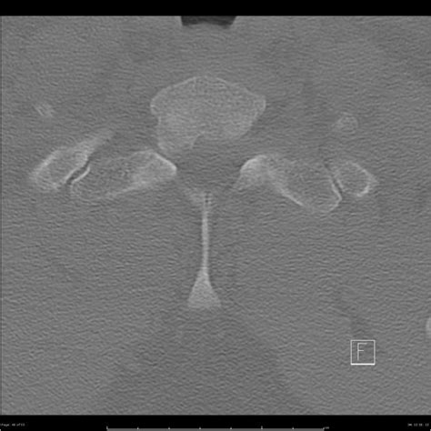 Bilateral Cervical Ribs Radiology Case