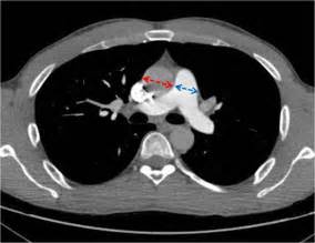 Ct Features Of Pulmonary Arterial Hypertension And Its Major Subtypes