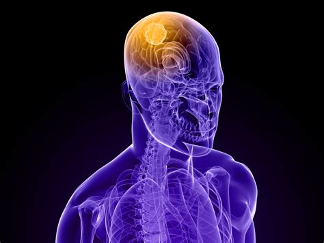 Brain Tumors Fact Vs Fiction Part Ii American Council On Science