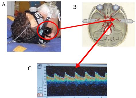 2 Image Of The Transcranial Doppler Ultrasound Tcd Probe Being Held