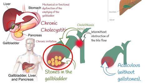 Cholecystitis Signs And Symptoms Chronic And Acute Cholecystitis