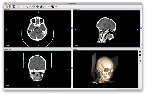 Invesalius Open Source 3d Medical Imaging Reconstruction Program