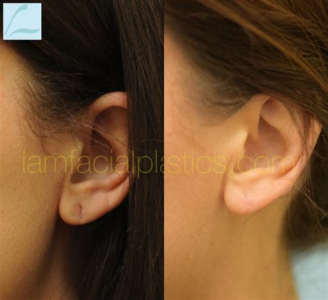 Dallas Torn Earlobe Repair Before And After Photos Plano Plastic