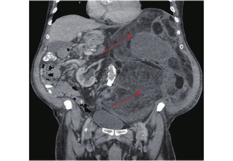 Liposarcoma Imaging Computed Tomography Image Shows An Extremely