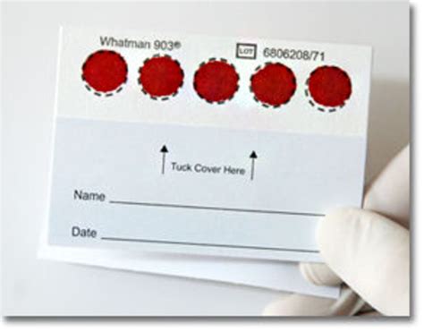 Dry Blood Spot Card Image Eurekalert Science News Releases