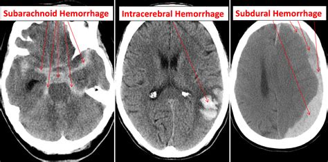 Subdural Hemorrhage Information On Brain Bleeds