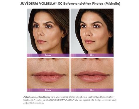 Volbella Swelling Lips