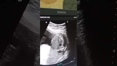 Karena menurutnya, bentuk perut hamilnya terkesan melebar, yang diyakini oleh masyarakat menunjukkan bayi perempuan. Gambar Usg Bayi 5 Bulan Dalam Kandungan - Info Terkait Gambar