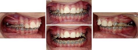 Treatment Effects Of The Carrière Distalizer Using Lingual Arch And Full Fixed Appliances
