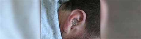 Fungal Ear Infection General Center