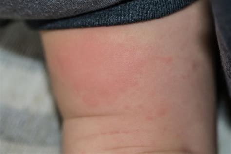 Allergic Reaction In Baby Treatment And Pictures