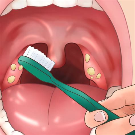 How To Completely Get Rid Of Tonsil Stones Perpetually Kazimbal
