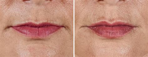 What Filler Is Best For Lip Lines Consuela Ritchey