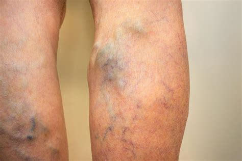 Spider Veins Causes Treatment And Prevention