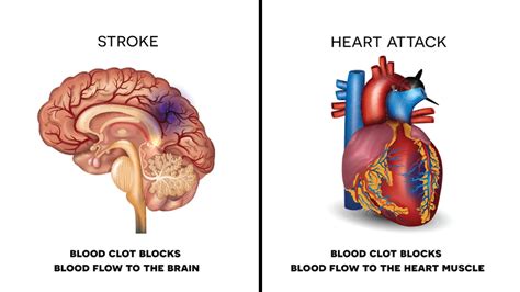 Stroke Attack A Stroke May Be Caused By A Blocked Artery Ischemic