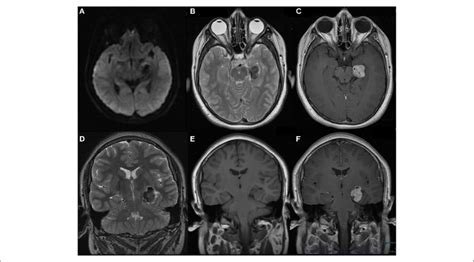 Mri Brain With And Without Contrast Obtained At Onset Of Seizures