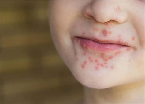 How To Recognise The Symptoms Of Hand Foot And Mouth Disease