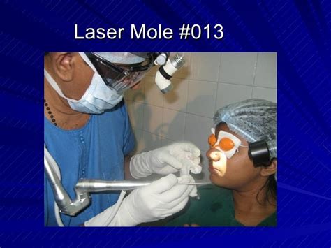 Laser Surgery Facial Moleby Drkopaulose Frcs Dlo
