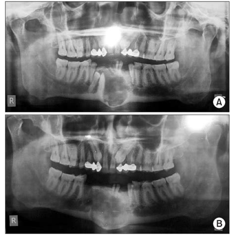 A Preoperative Panoramic Radiograph Shows Unilocular Lucency Extending
