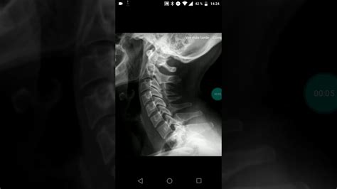 Radiografía De Columna Cervical Perfil DescripciÓn Youtube