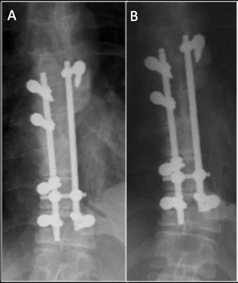 Ap Thoracic Spine Post En Bloc Resection A Showing Development Of