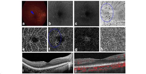 Imaging Of The Right Eye Of Patient 4 Capillary Variations Are Visible