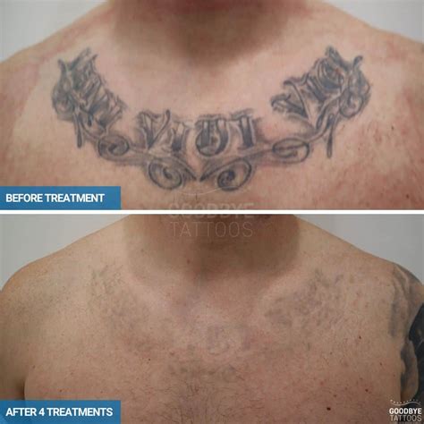 Update 69 Laser Tattoo Removal Before And After Best Vn