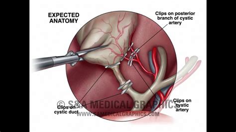 Laparoscopic Cholecystectomy Animation Youtube