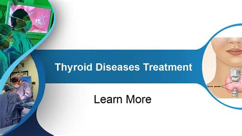 Thyroid Diseases Treatment